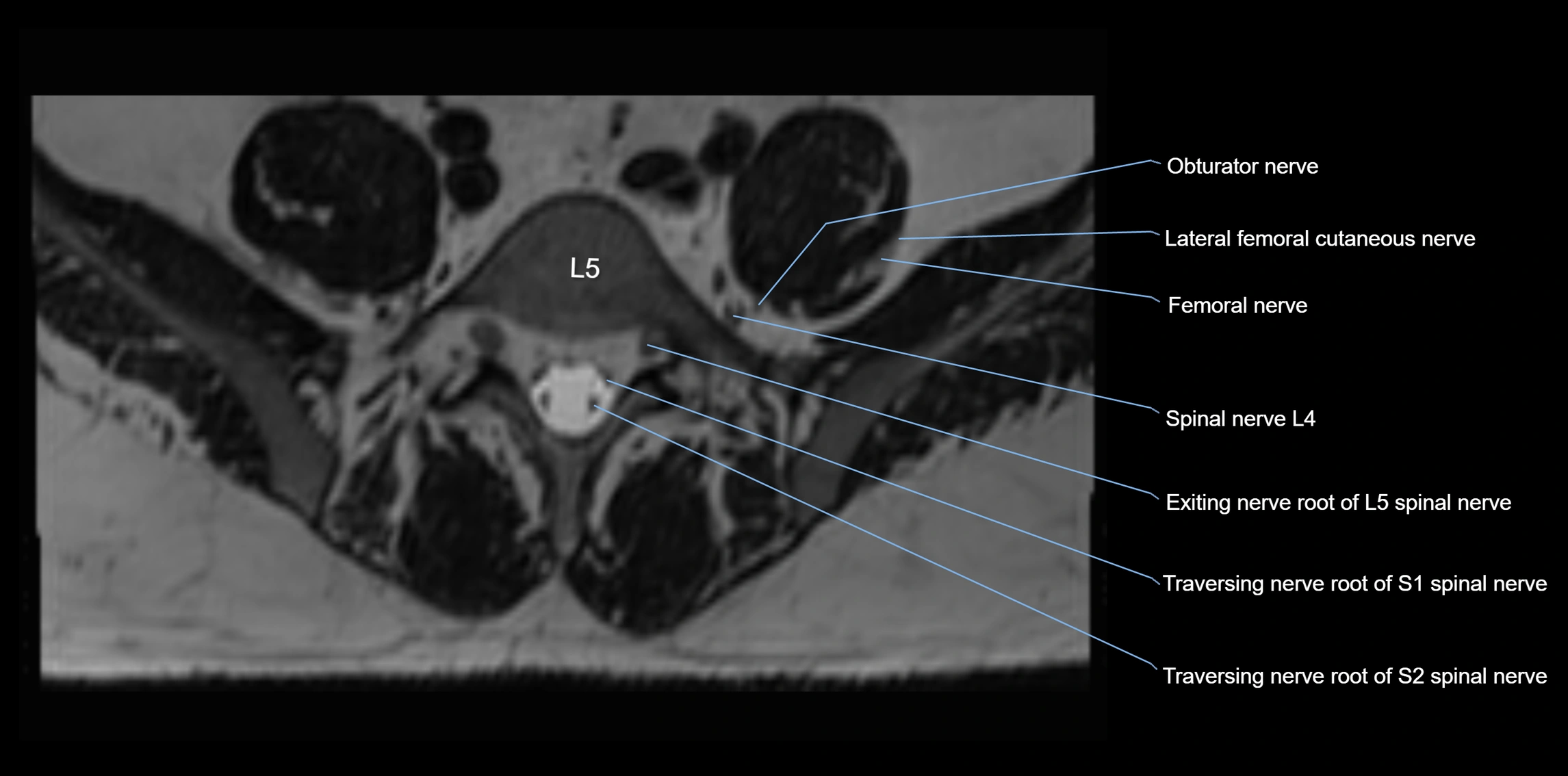 MR lumbosacral plexus axial cross sectional anatomy 3T  radiology  image-img-1008001-00057.webp